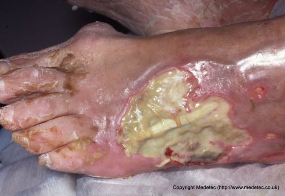 Sloughy wound on dorsum of foot with tendon expo photo picture